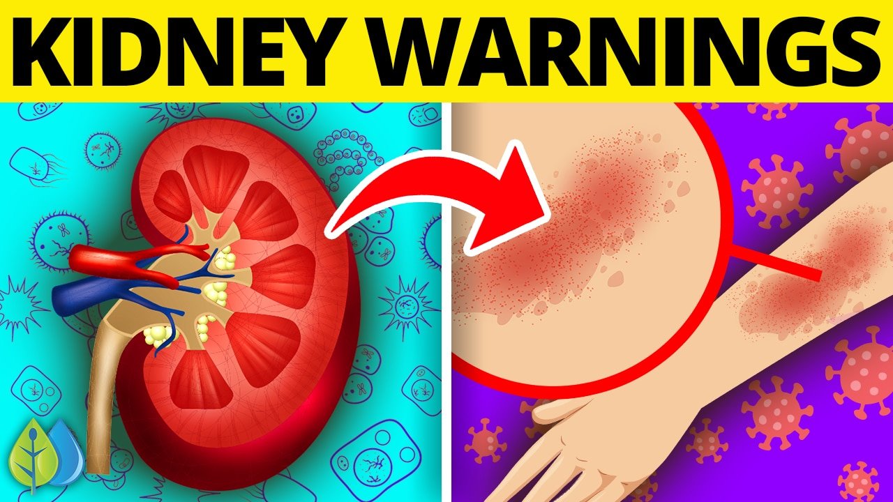 10 Early Signs Your Kidneys Are Toxic (Chronic Kidney Disease)
