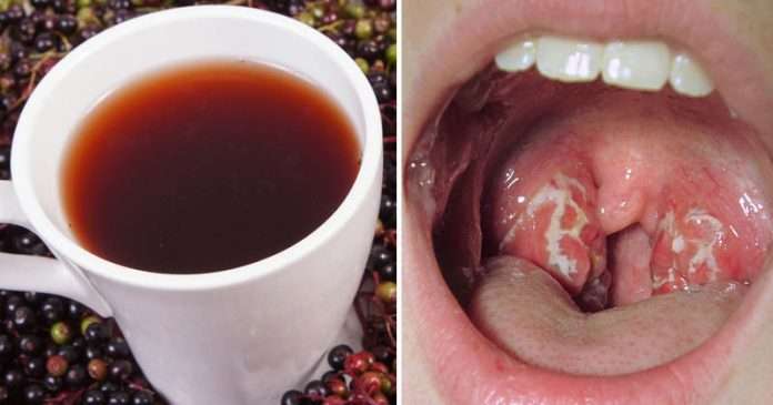10 Remedies That Defeat Strep Throat In No Time!