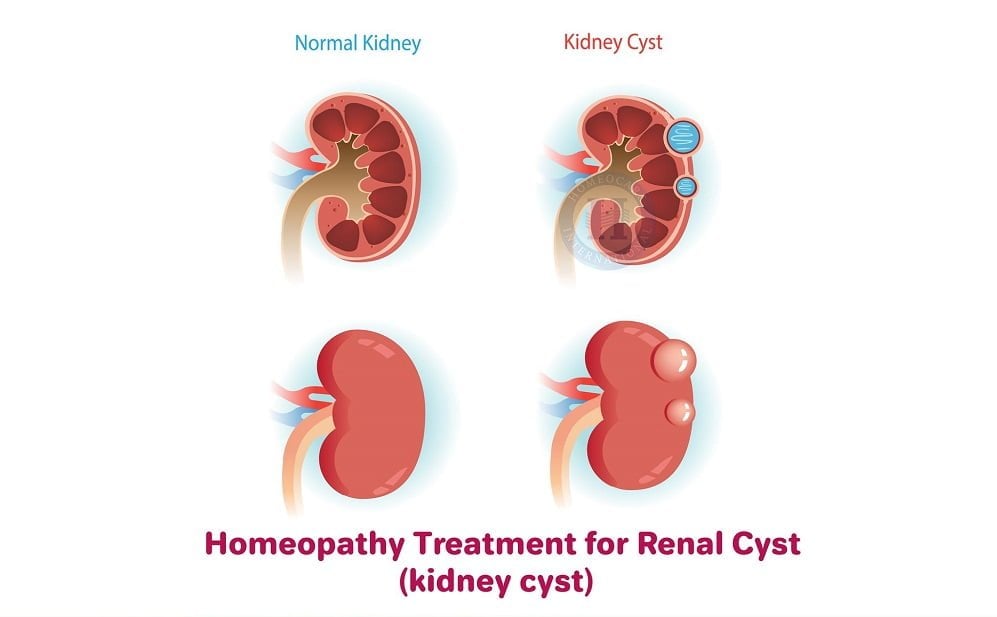 17 Best Kidney Cysts Home Remedies