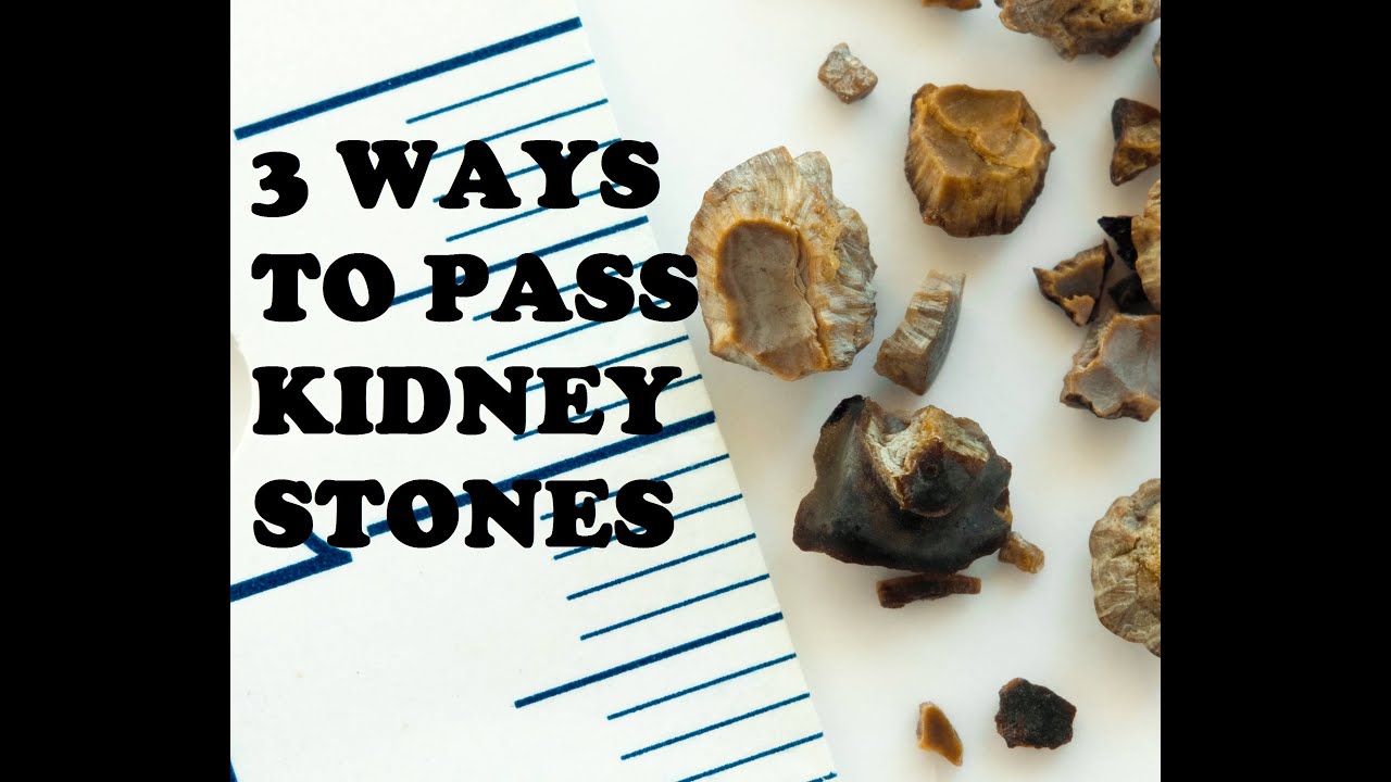 3 Ways To Pass Kidney Stones