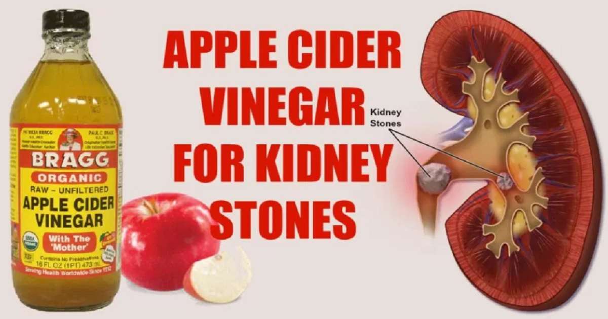 4 Ways To Help Dissolve Kidney Stones Naturally Using Apple Cider Vinegar!