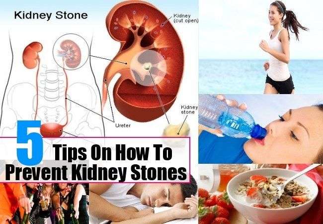 5 Tips On How To Prevent Kidney Stones