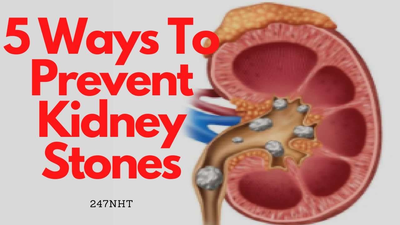 5 Ways To Prevent Kidney Stones