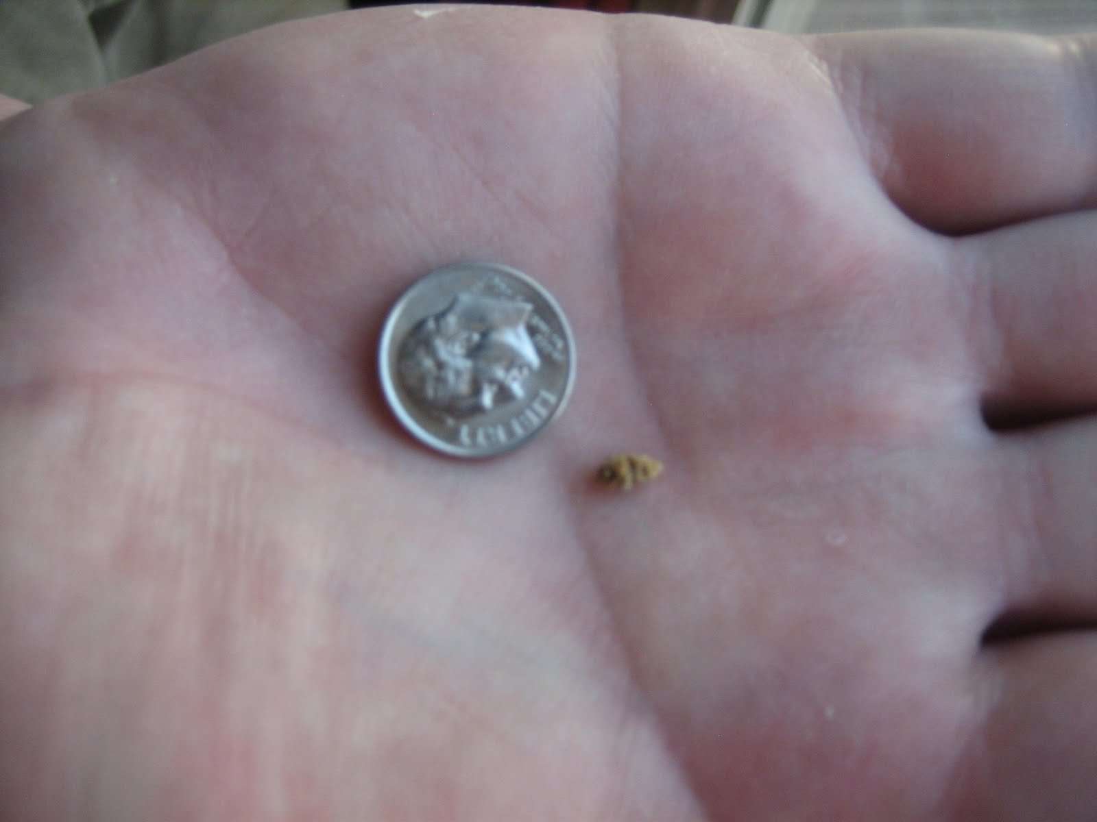 6mm Kidney Stone Actual Size