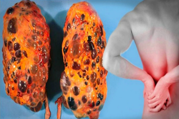 7 Bad Habits That Are Damaging Your Kidneys. YOU MUST ...