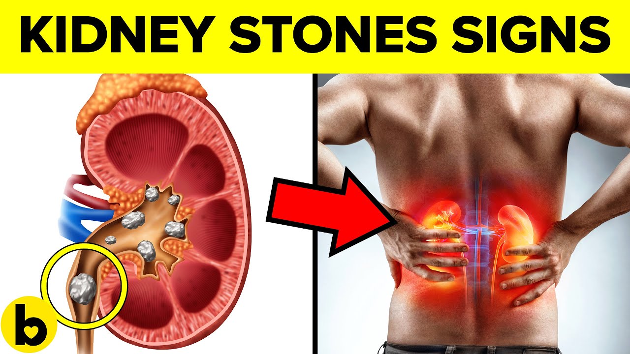 7 Warning Signs of Kidney Stones you must Know