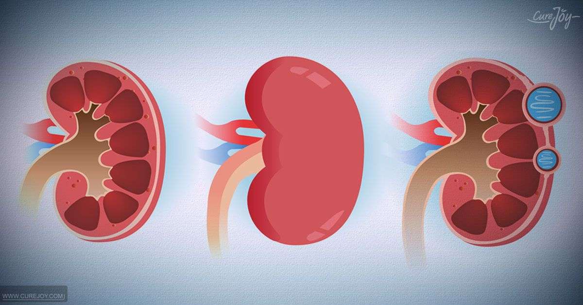 8 Prominent Symptoms Of Kidney Failure