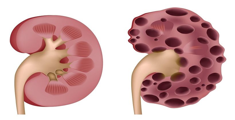 8 Things That Can Hurt Your Kidney