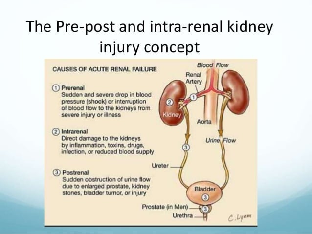 Acute Kidney Injury Prerenal Intrarenal Postrenal