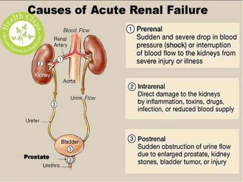 Acute Kidney Injury Stage 1 Treatment