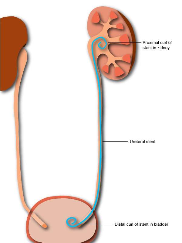 What Does A Kidney Stent Look Like