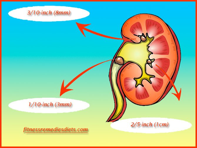 All You Need To know On How to Avoid Kidney Stone (Foods ...