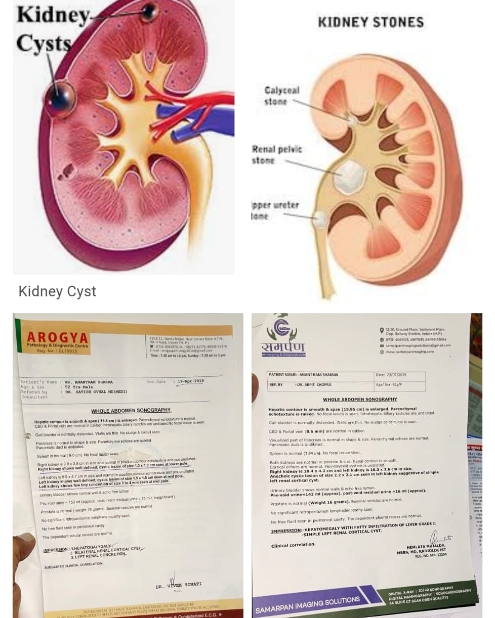 Anechoic Cyst Kidney Treatment