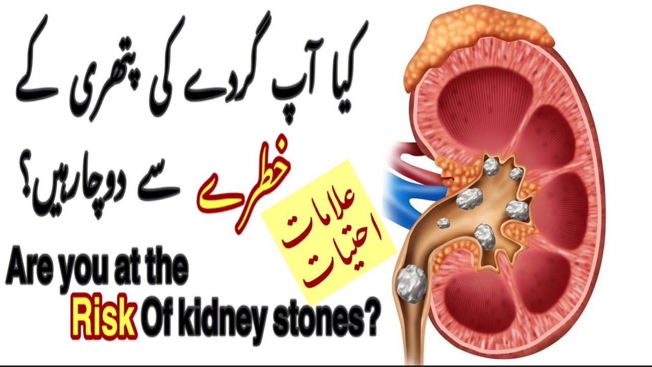 Are You At The Risk Of Kidney Stones?