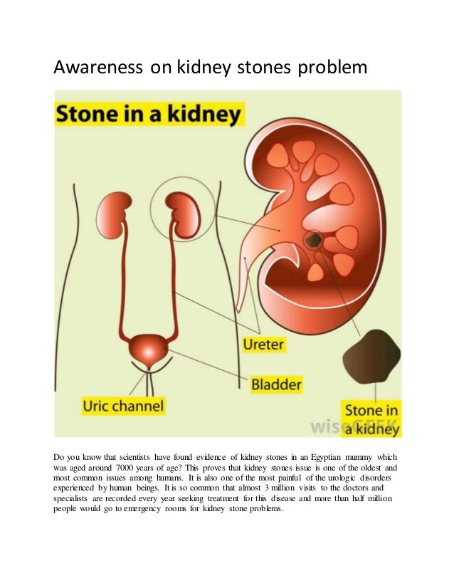 Awareness on kidney stones problem_POSITIVE HOMEOPATHY