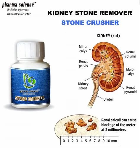 Ayurvedic Medicine For Kidney Stone, For Personal, Packaging Size: 10*8 ...