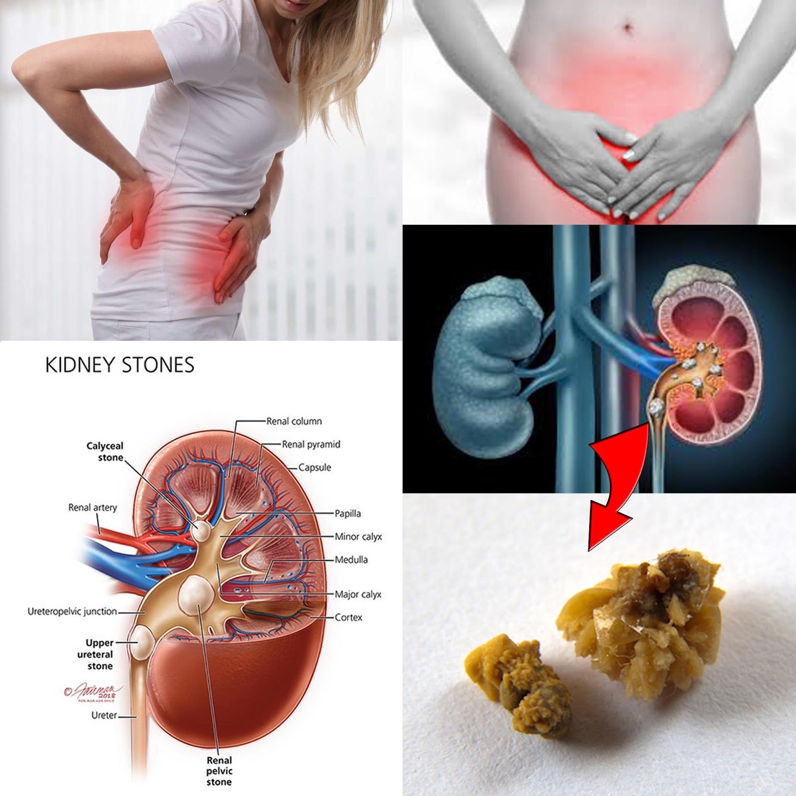 what-size-kidney-stone-is-too-big-to-pass-healthykidneyclub