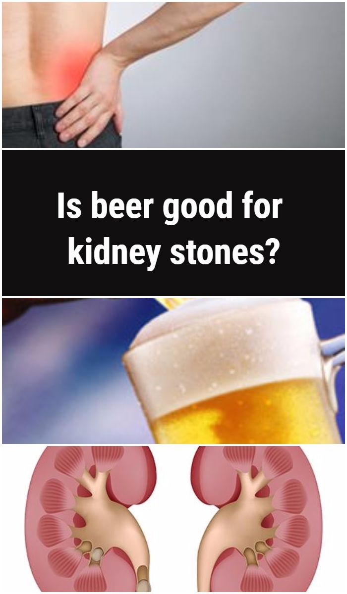 Beer And Kidney Stones
