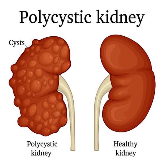 Best Polycystic Kidney Disease (PKD) Treatment in Ayurveda