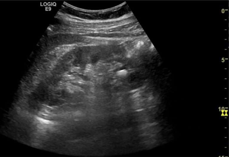 Bladder Stone: Case 1  LITFL  Ultrasound Clinical Cases