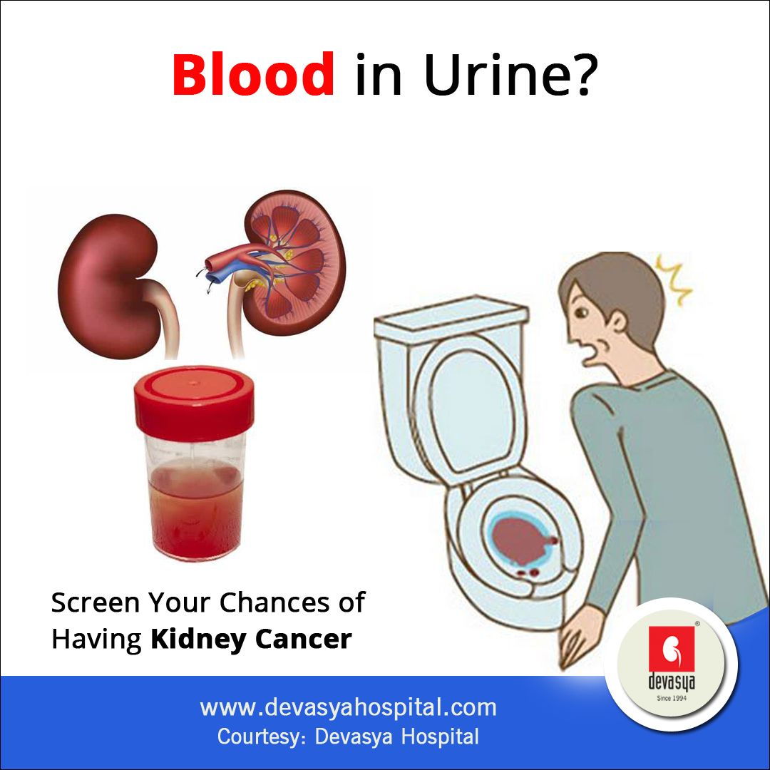 Can Passing Kidney Stones Cause Blood In Urine HealthyKidneyClub