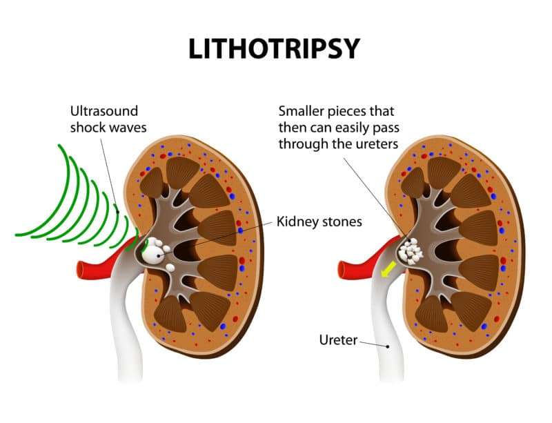 Breaking 3 mm to 8 mm Stones in Ureter: Specialists in ...