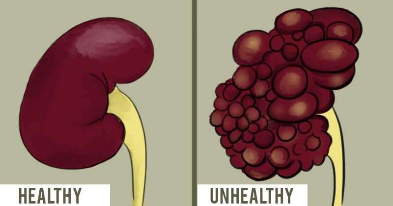 how-can-your-kidneys-get-damaged-healthykidneyclub