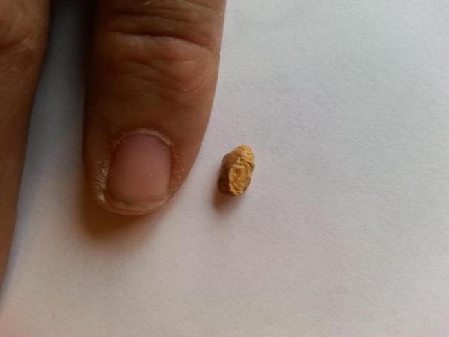 Can 7mm Kidney Stone Pass