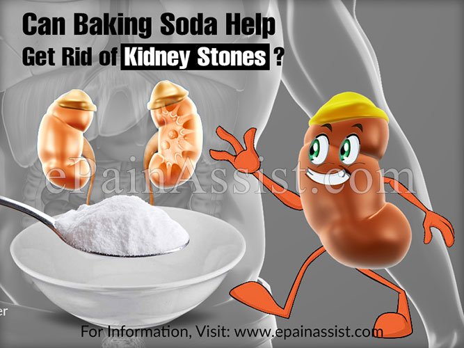 Can Baking Soda Help Get Rid of Kidney Stones?