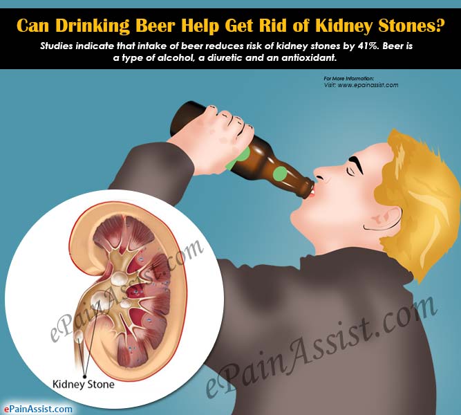 Can Drinking Beer Help Get Rid of Kidney Stones