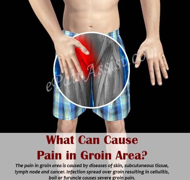 Can Kidney Stones Cause Back Pain And Groin Pain