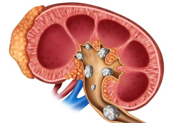Can kidney stones cause blood in urine?