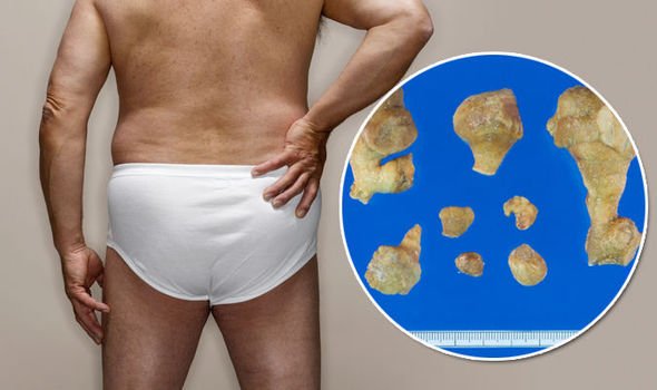 Can Kidney Stones Pass During Ejaculation