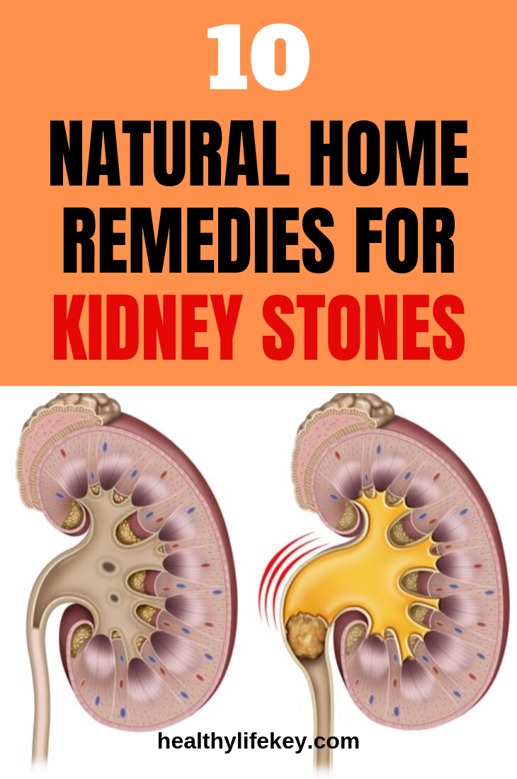 Can You Have Kidney Stones Without Pain