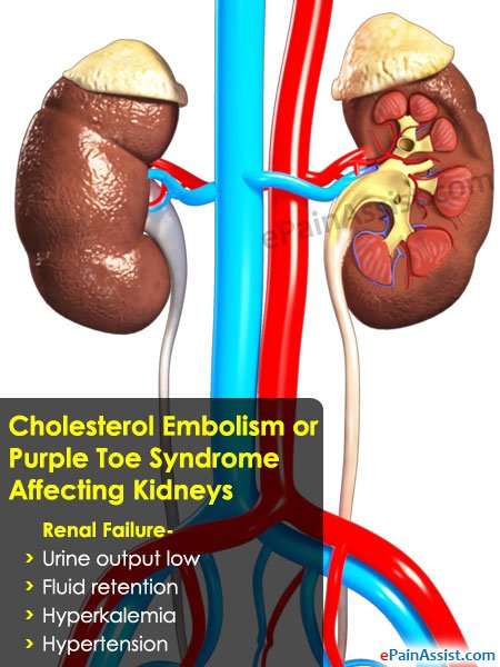 Cholesterol Embolism or Purple Toe Syndrome