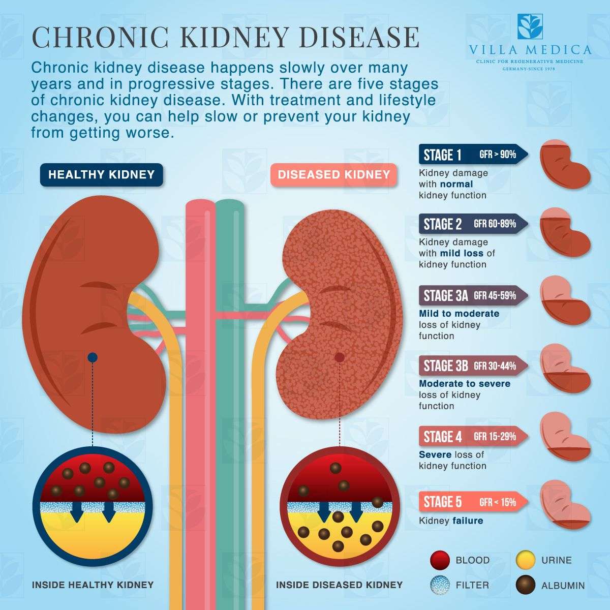 Chronic Kidney Disease Infographic (With images)
