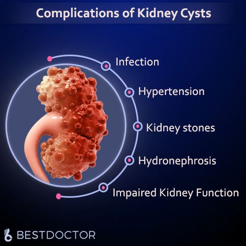 Complications Of Kidney Cysts
