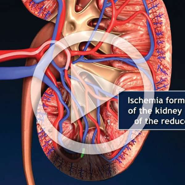 CTA Embolization of the Kidney