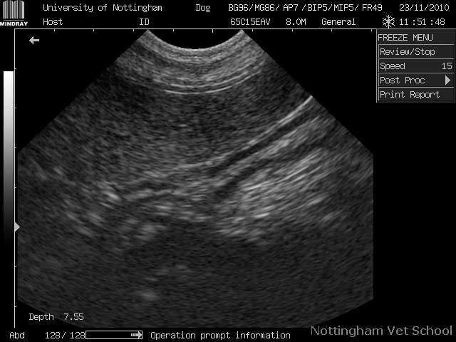 Dark Spots On Kidney Ultrasound