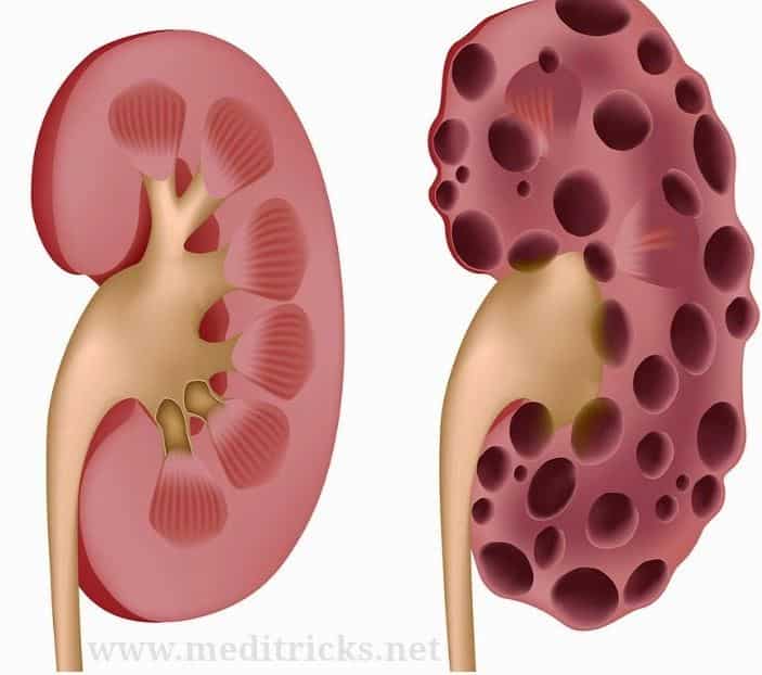Detoxify Kidneys Effectively With This Unbelievable Tea