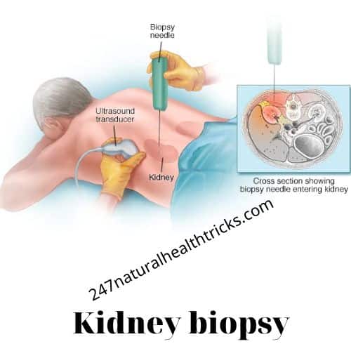 Diagnosis &  Treatment Chronic Kidney Disease