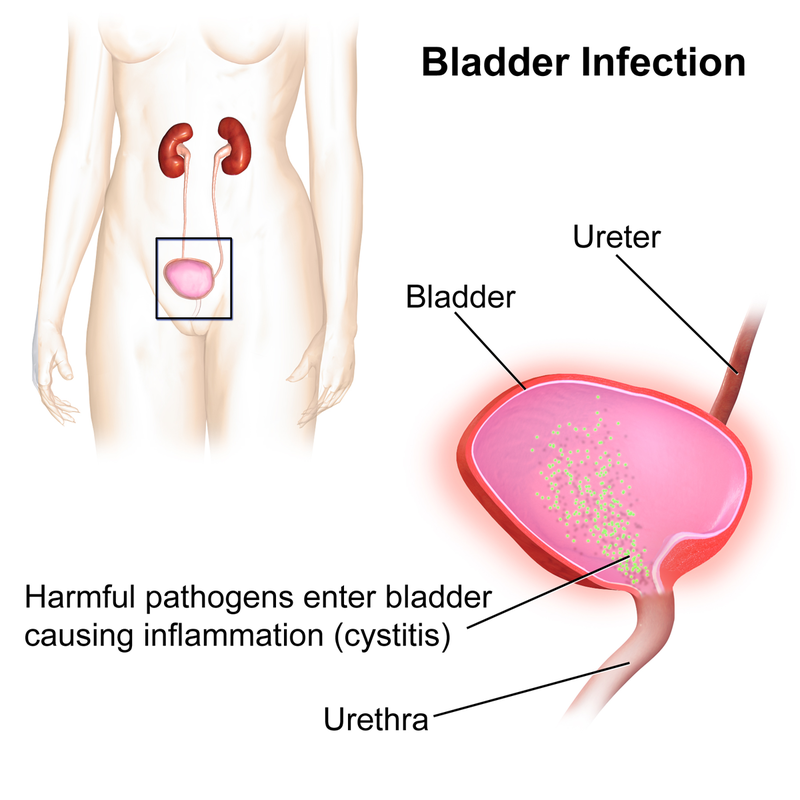 Difference Between UTI and Bladder Infection