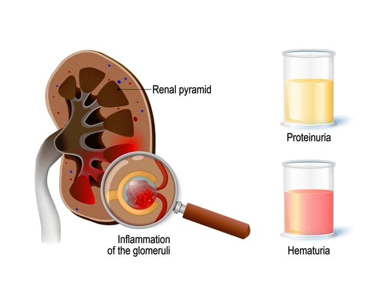 Disease Graphics, Videos &  Images on Blood in Urine (Hematuria)