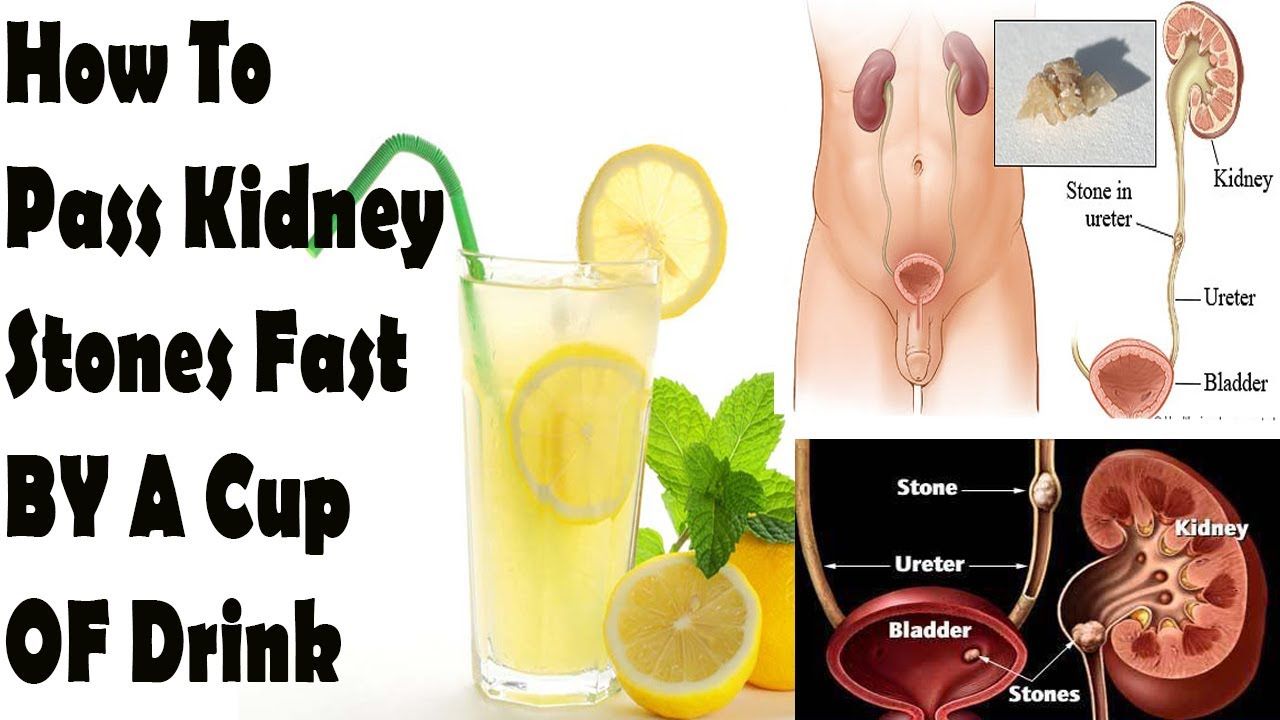 Do Energy Drinks Make Kidney Stones
