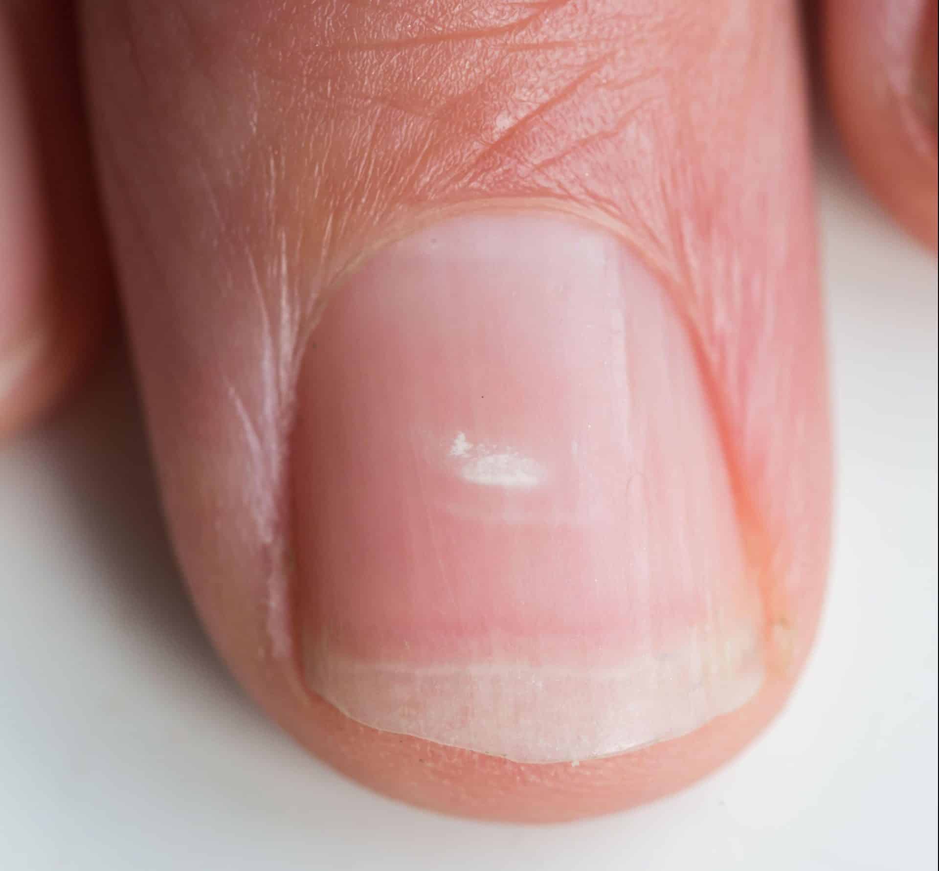 Do you have white marks on your fingernails? This is what they mean ...