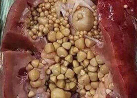 Does this photo of kidney stones show the effect of energy drinks?