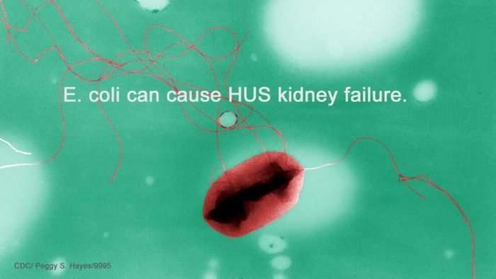 E. coli and HUS Kidney Failure Treatment