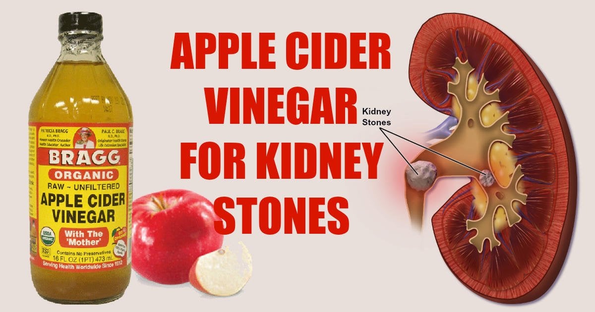 Easy Ways To Use Apple Cider Vinegar For Kidney Stones ...