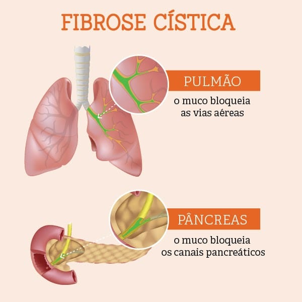 Fibrose Quistica : O Que E A Fibrose Quistica Farmacias Portuguesas