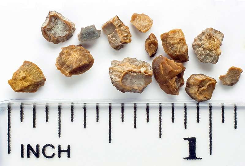 Find How To Pass A Kidney Stone Faster To Get Inspired ...